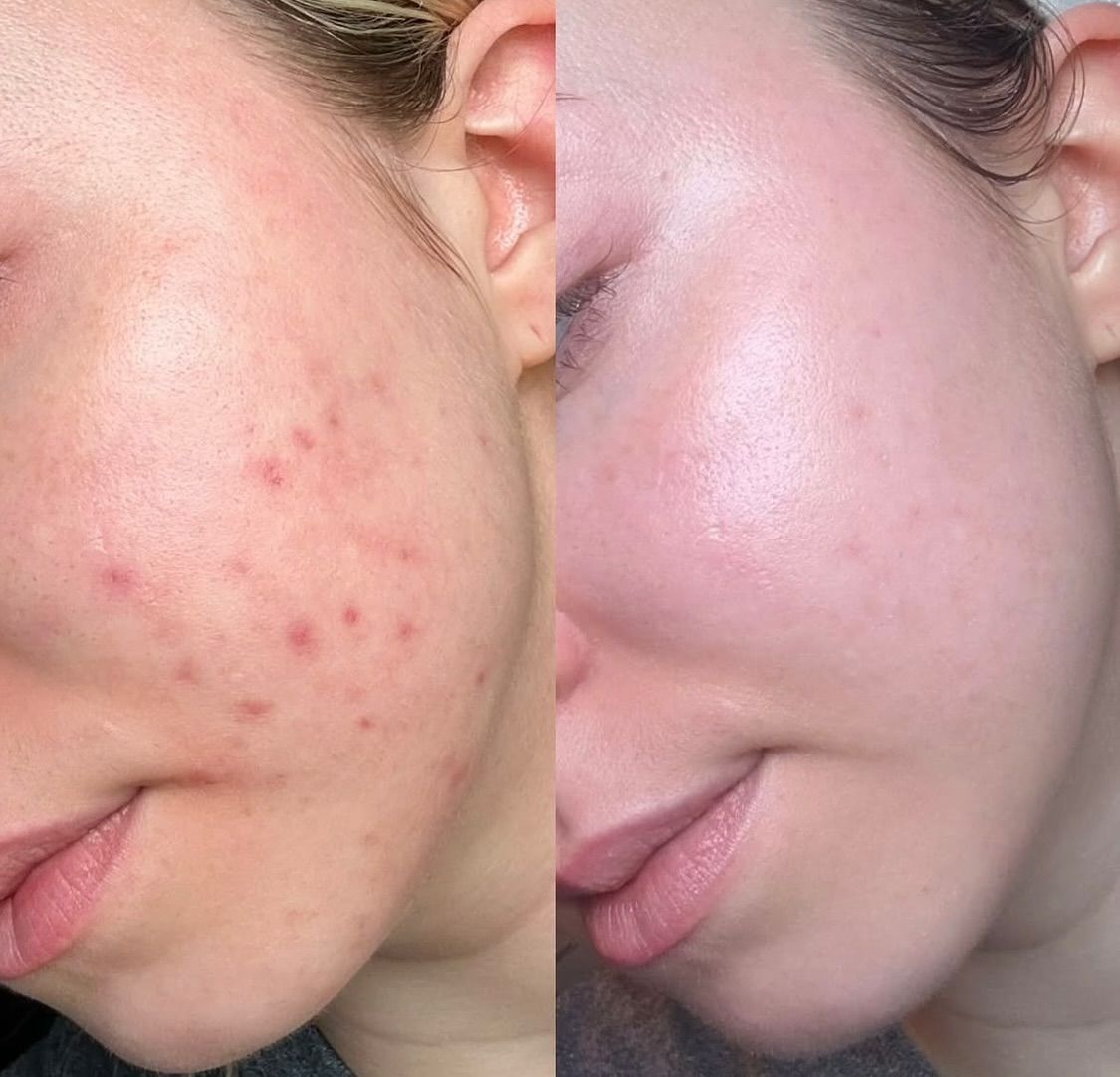 Serum secador de barros